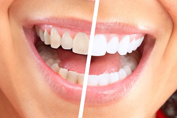 Professional Teeth Whitening Commonly Asked Questions